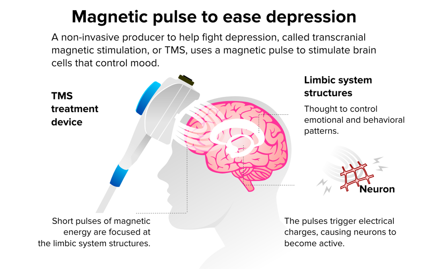 rTMS brain stimulation therapy
