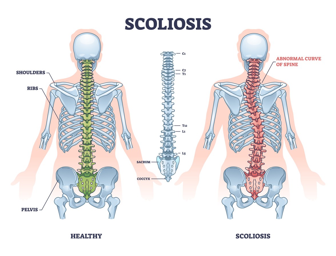 Silhouette of spine with highlighted curvature, representing scoliosis posture correction