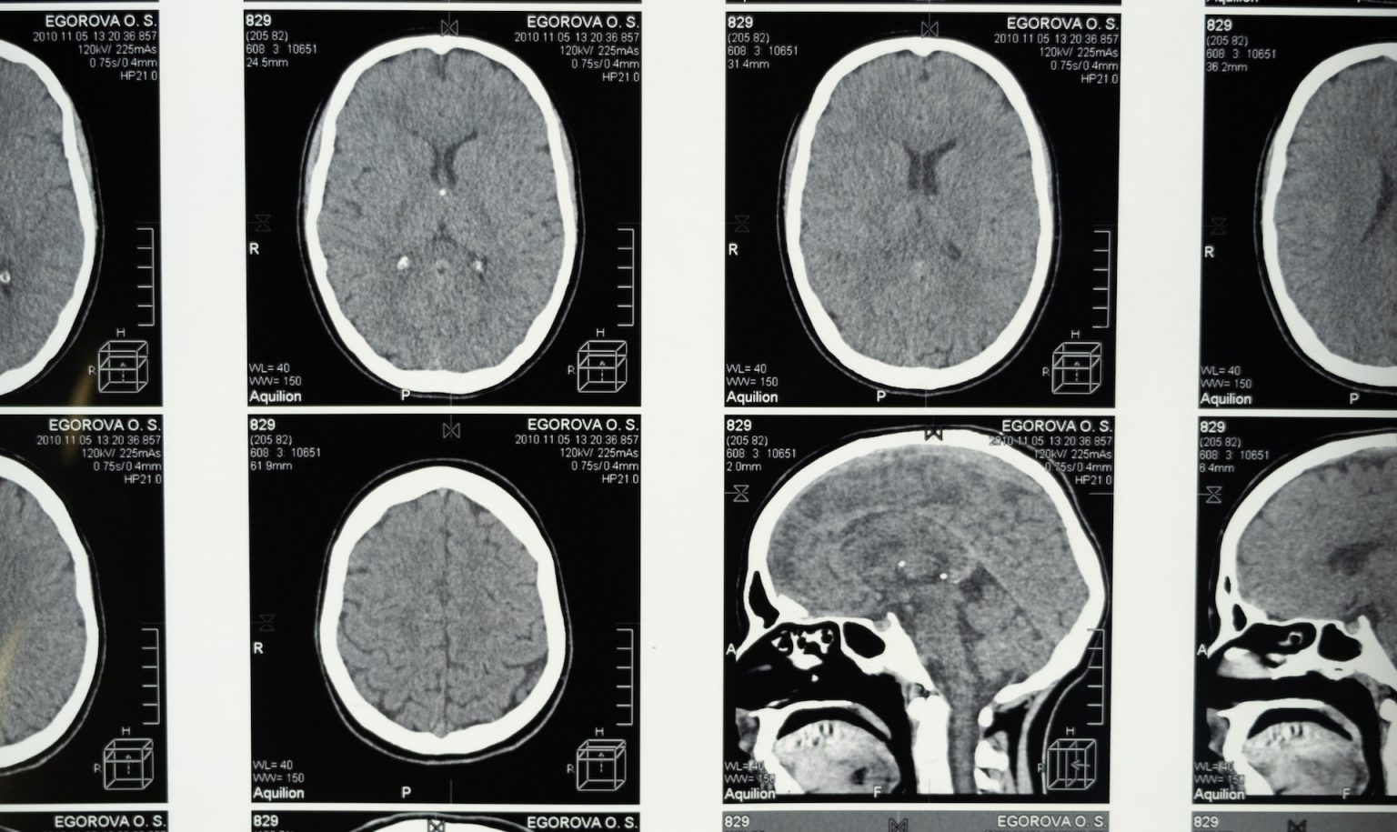 MRI scan showing frontal lobe brain damage