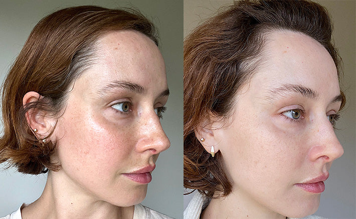 Real skincare before and after transformation showing visible results