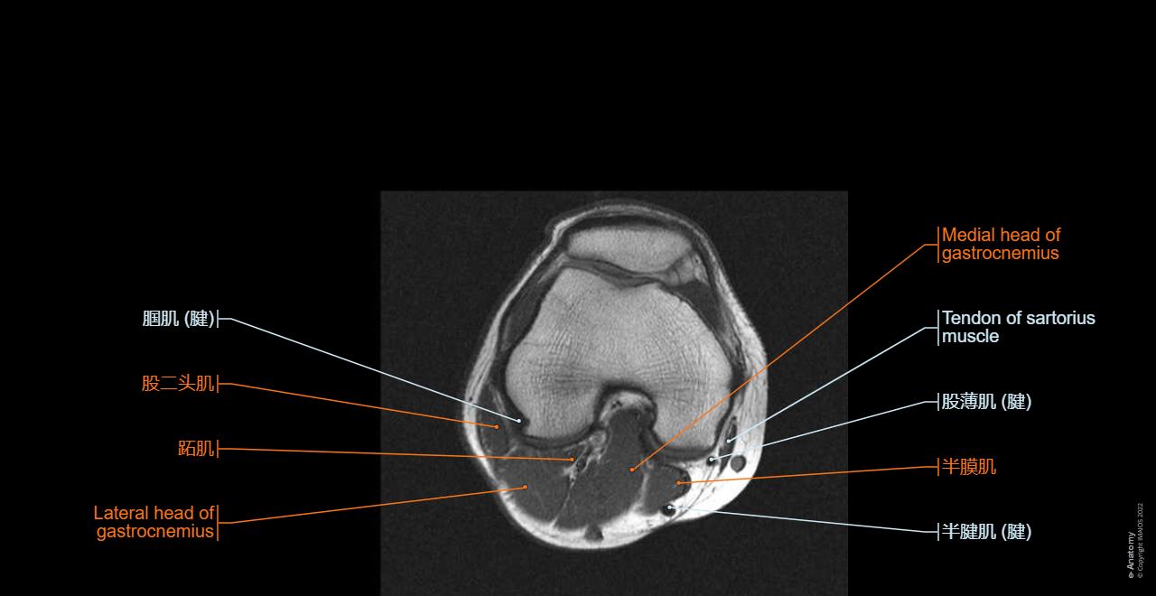 膝关节3D MRI成像