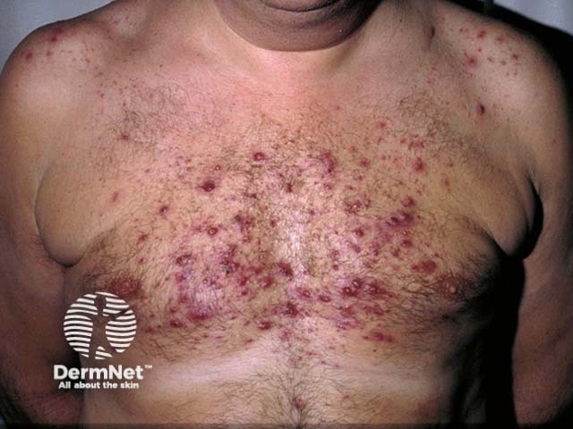 Pele do peito de homem com acne severa causada pelo uso de esteroides anabolizantes