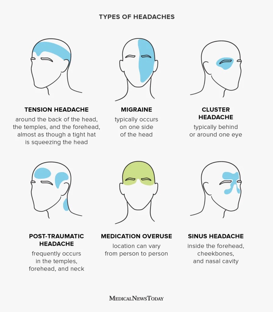 Headache location chart showing pain areas for different types