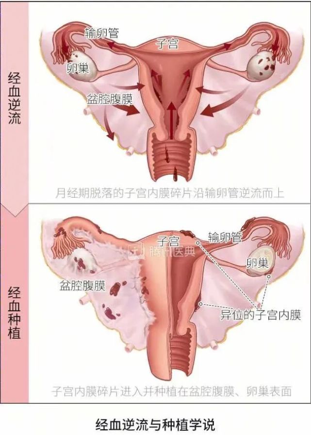 子宫内膜异位症的医学示意图