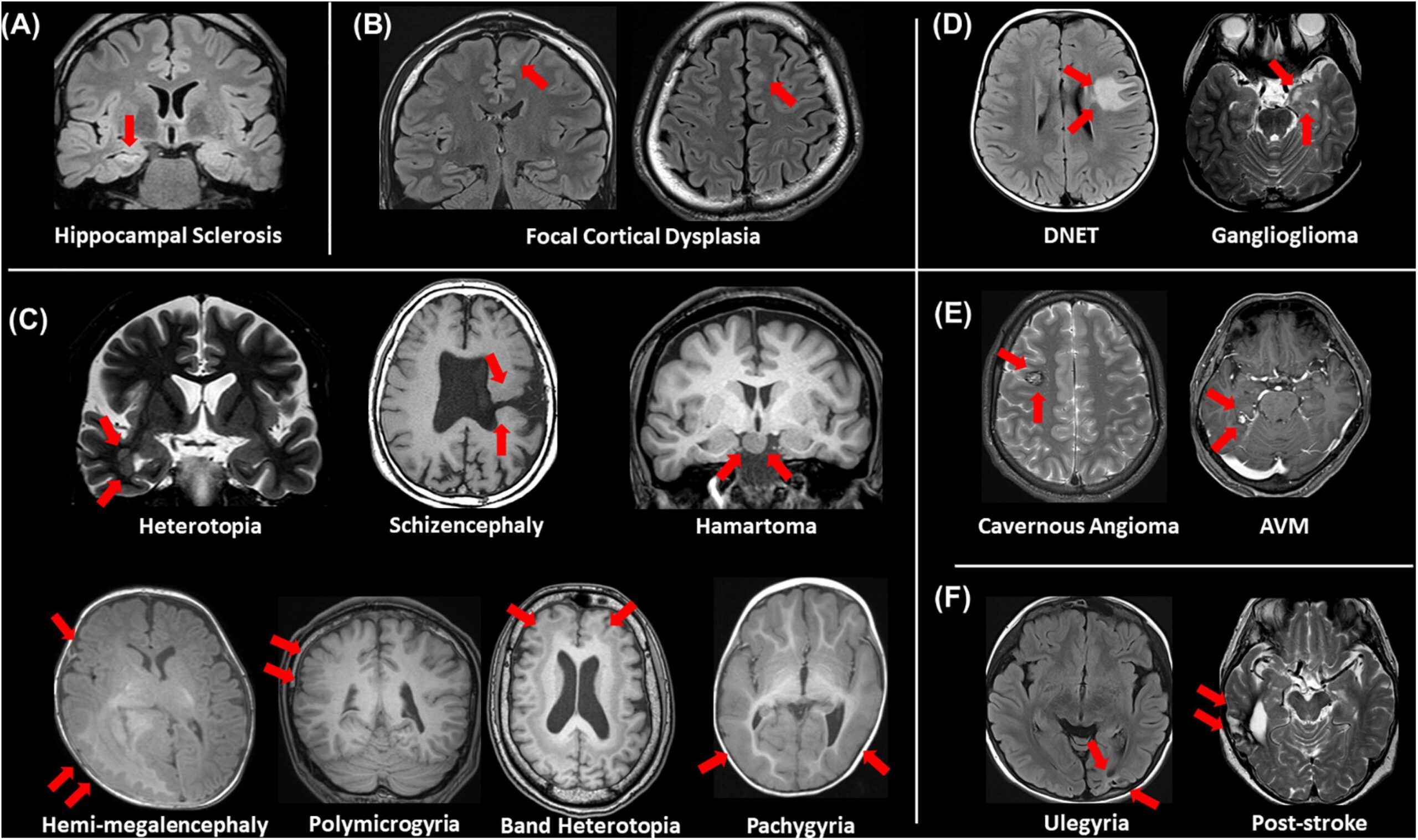 The Impact of Advanced MRI in Neurological Research