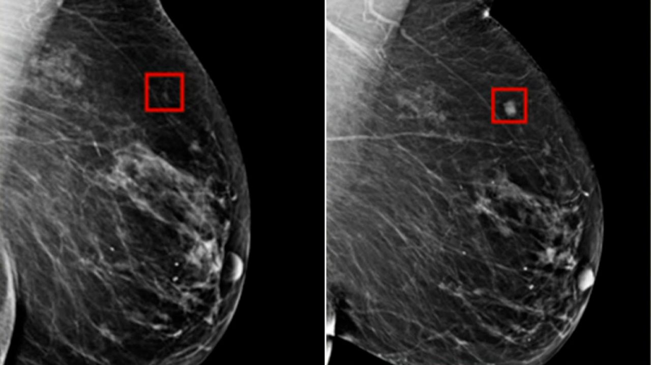 Breast cancer MRI scan showing tumor detection