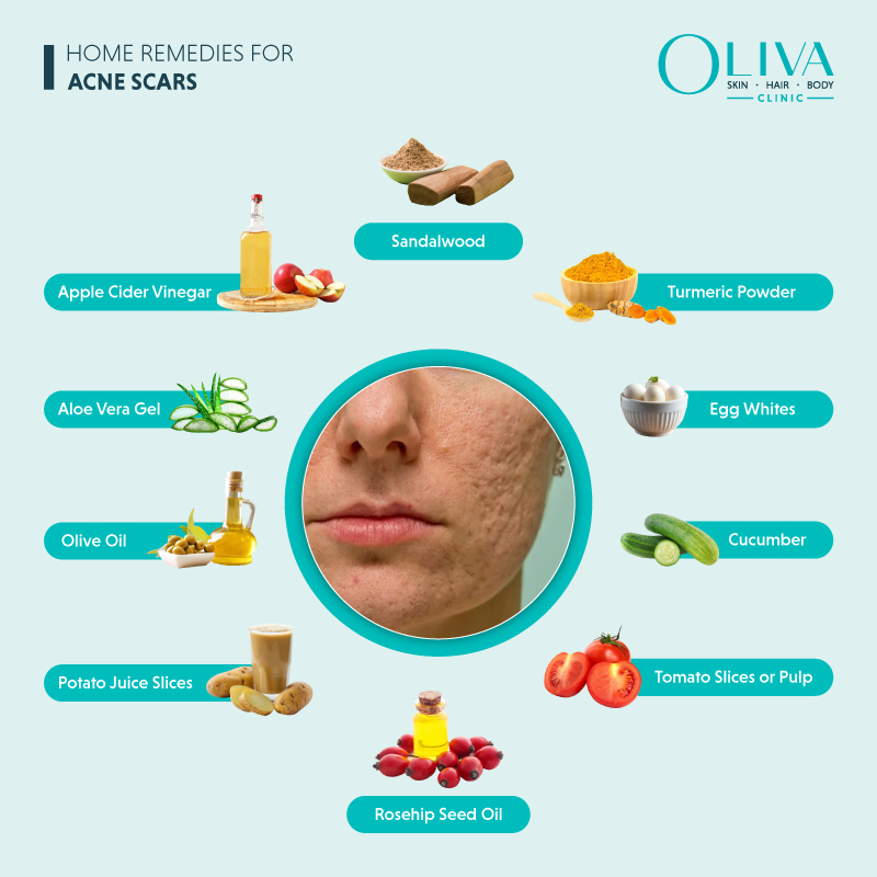 Natural home remedies for acne scars including aloe vera, turmeric, honey, and apple cider vinegar