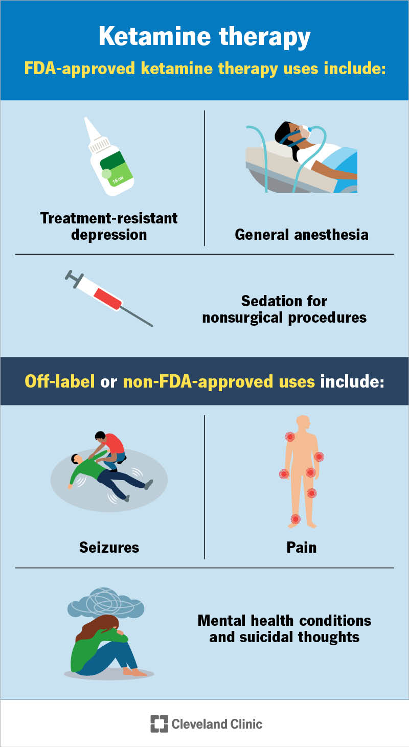 Ketamine therapy infographic
