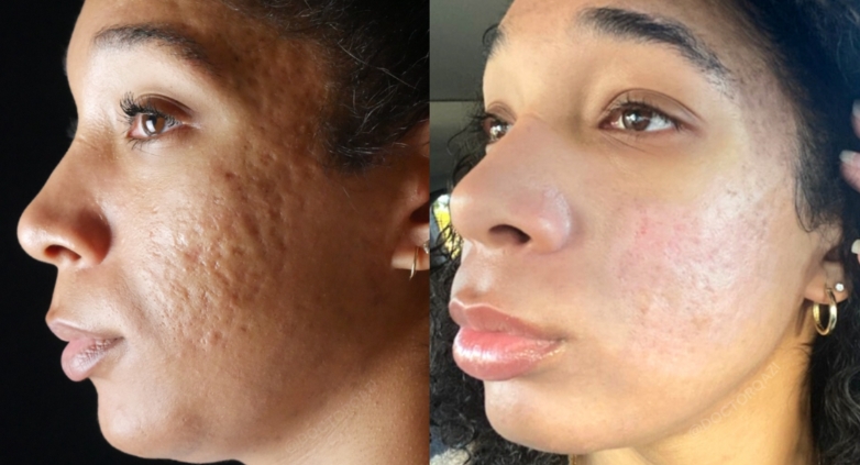 Before and after results of natural acne scar treatment showing skin texture improvement