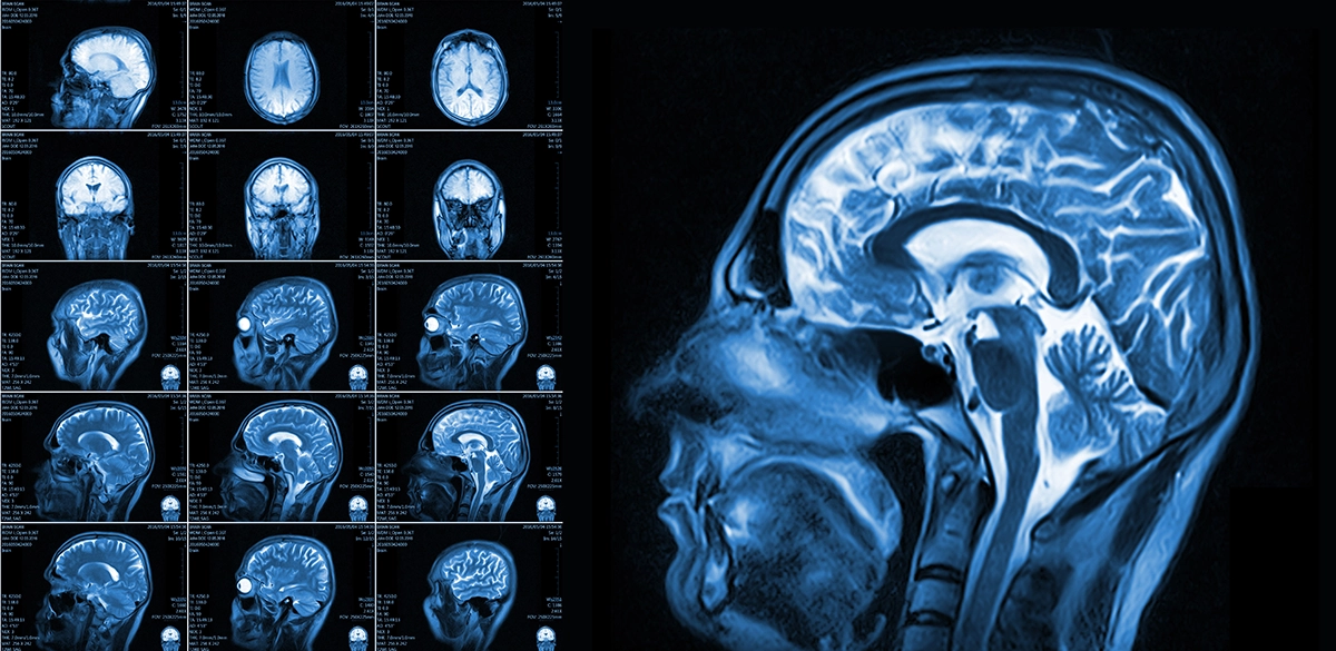 Why Would A Doctor Order an MRI of the Brain?