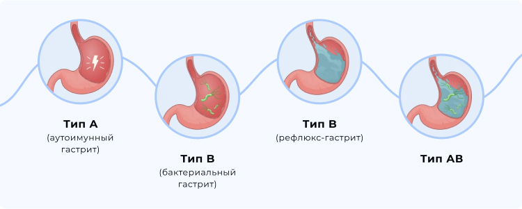 Типы гастрита