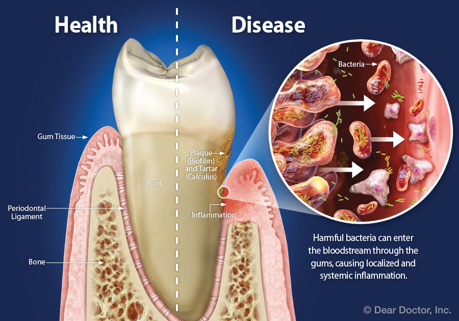 Periodontitis y salud sistémica