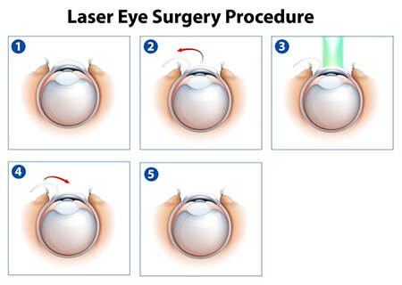 LASIK Steps - Delaware Ophthalmology Consultants