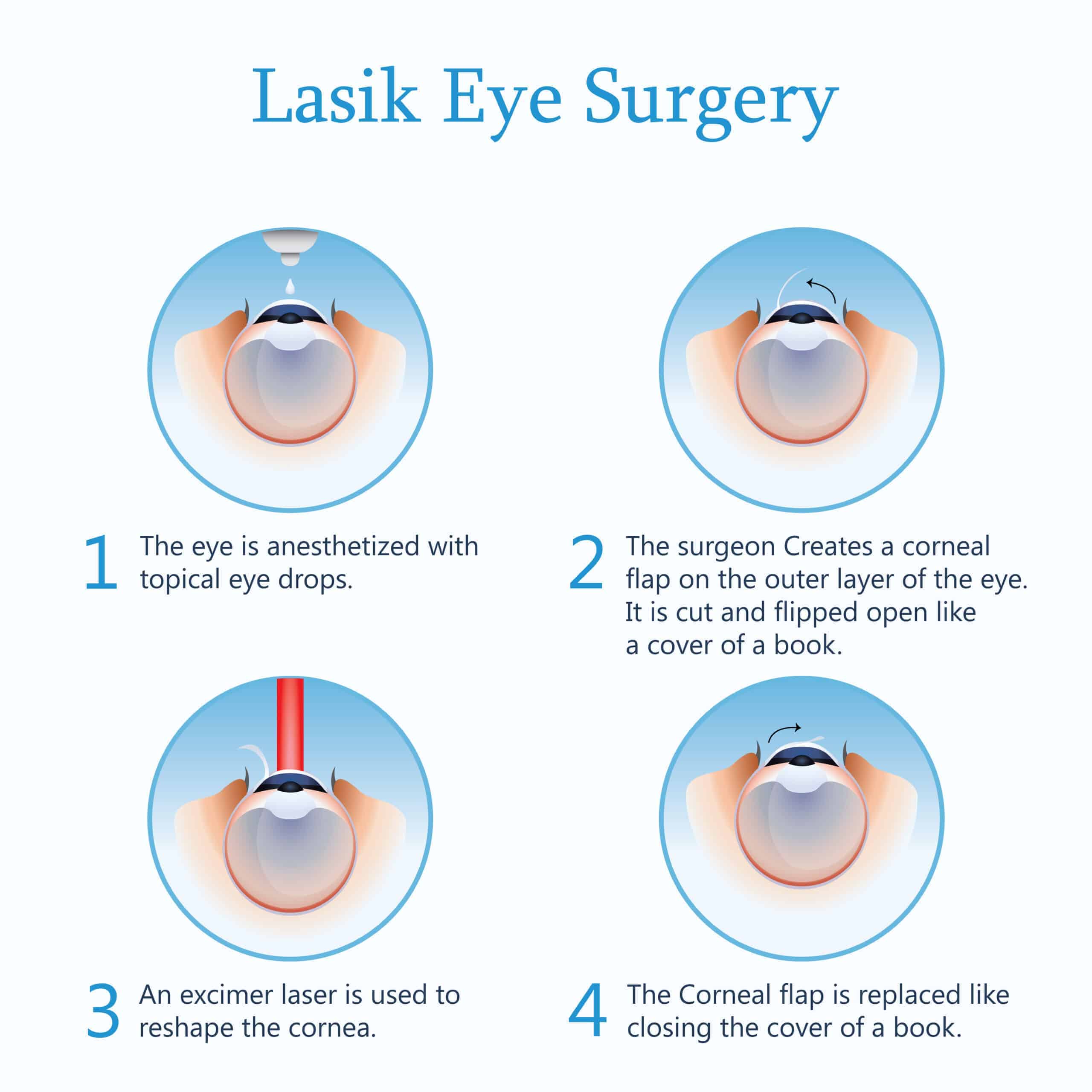 How Does LASIK Work: What You Need to Know