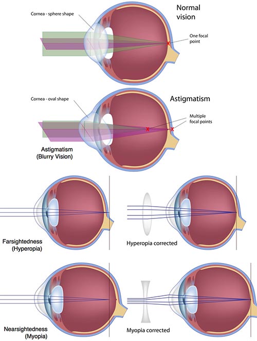 Types of LASIK Eye Surgery · Top Rated Doctor · NYC Ophthalmologist