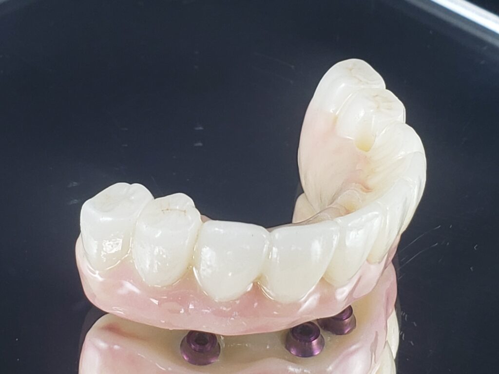 Zirconia Bridge