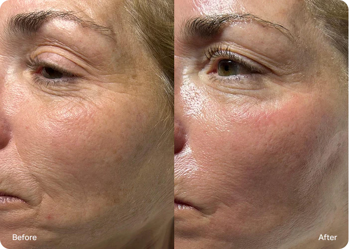 Radiofrequence visage avant apres