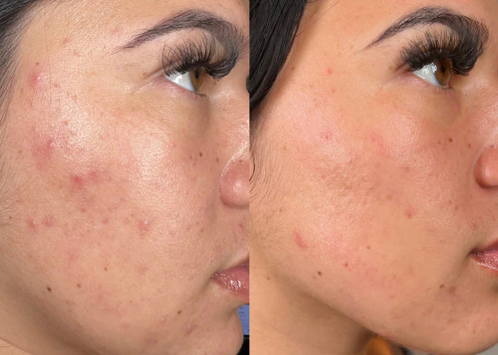 Hydrafacial acne avant apres