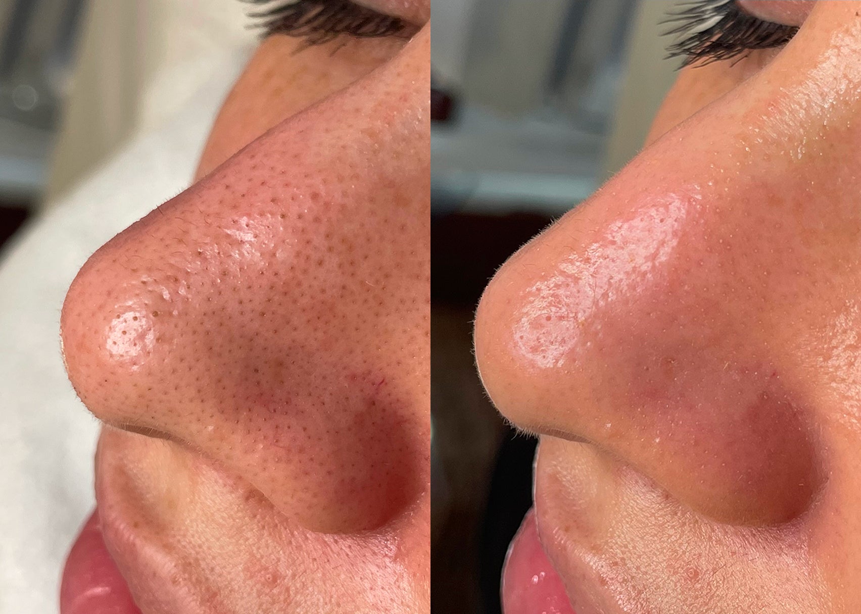 Hydrafacial avant apres
