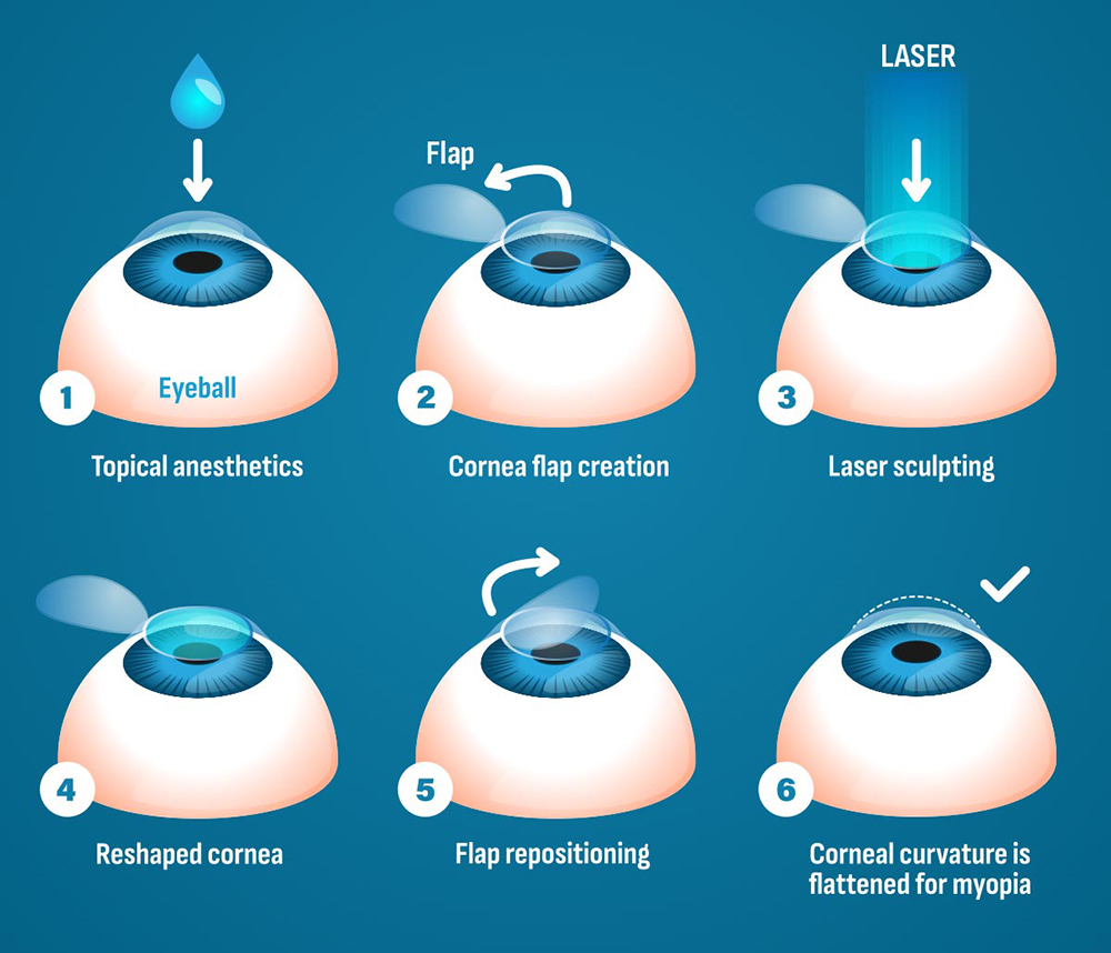 LASIK Surgery Chicago | LASIK Niles | Milwaukee Avenue Eye