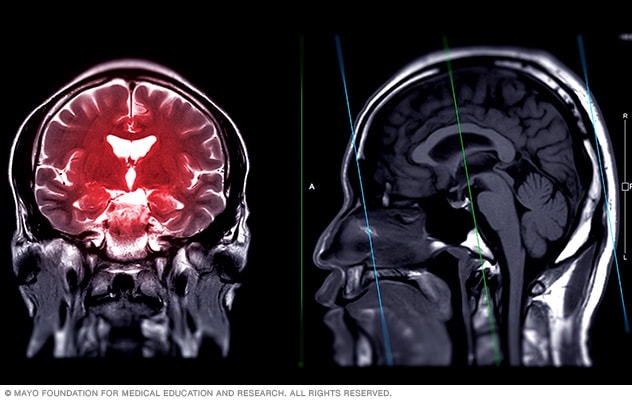 Brain MRI (brain magnetic resonance imaging) - Mayo Clinic