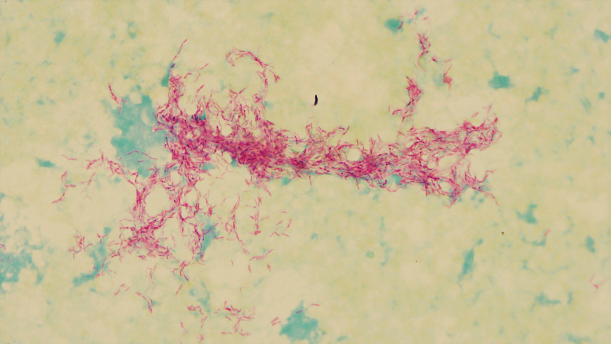 显微镜下的肺结核分枝杆菌