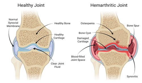 Hemophilia Joint Bleeding Medical Illustration - Healthy vs Hemarthritic Joint