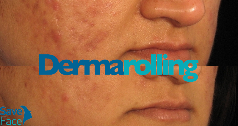 Dermaroller Körper Dehnungsstreifen