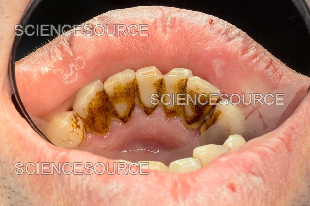 Dientes con acumulación de sarro y placa bacteriana que requiere limpieza dental profesional