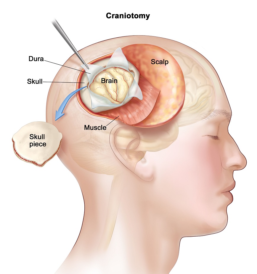 Brain Tumor Surgery - Advanced Craniotomy Procedure