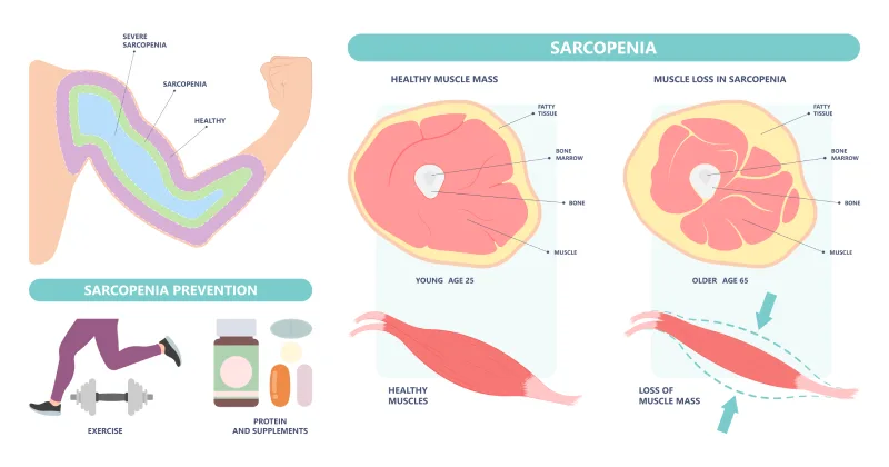Ilustración de sarcopenia